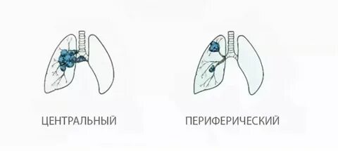Схема рака легкого