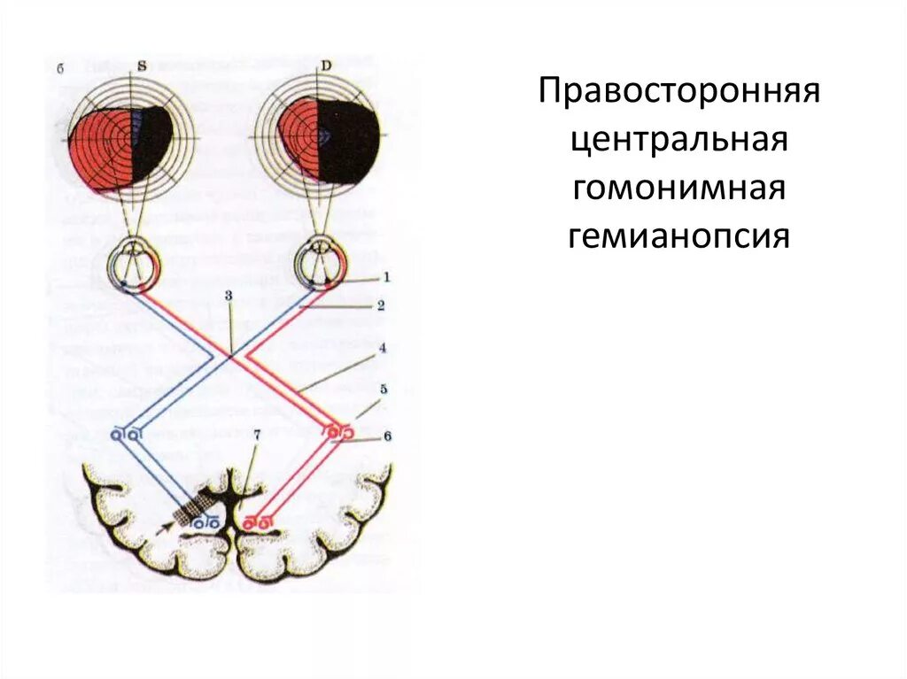 Правосторонняя гомонимная гемианопсия очаг поражения. Гетеронимная битемпоральная гемианопсия возникает при поражении. Битемпоральная гемианопсия причины. Битемпоральная гемианопсия причины. Правосторонняя гомонимная гемианопсия.