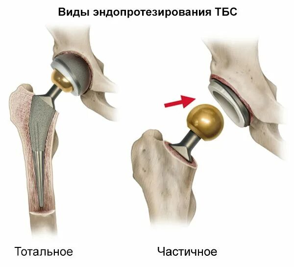 Виды тазобедренных протезов