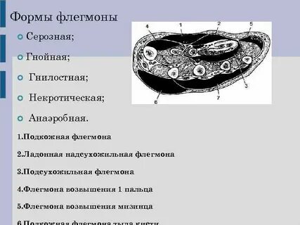 Флегмона новорожденных