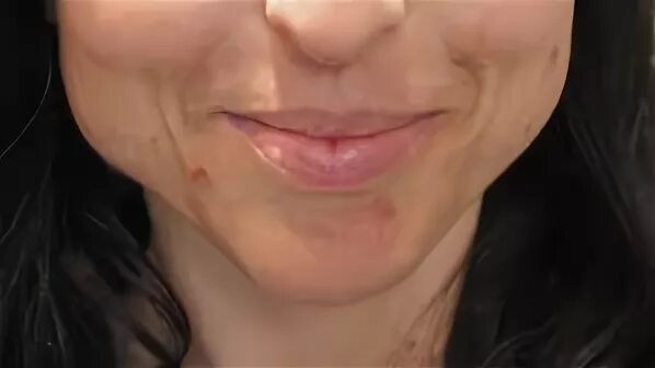 Ботокс в жевательные мышцы до и после. Гипертонус жевательных мышц. Гипертрофия жевательных мышц. Гипертрофия жевательных мышц. Гипертрофия жевательных мышц.