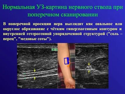 Узи периферических нервов верхних конечностей