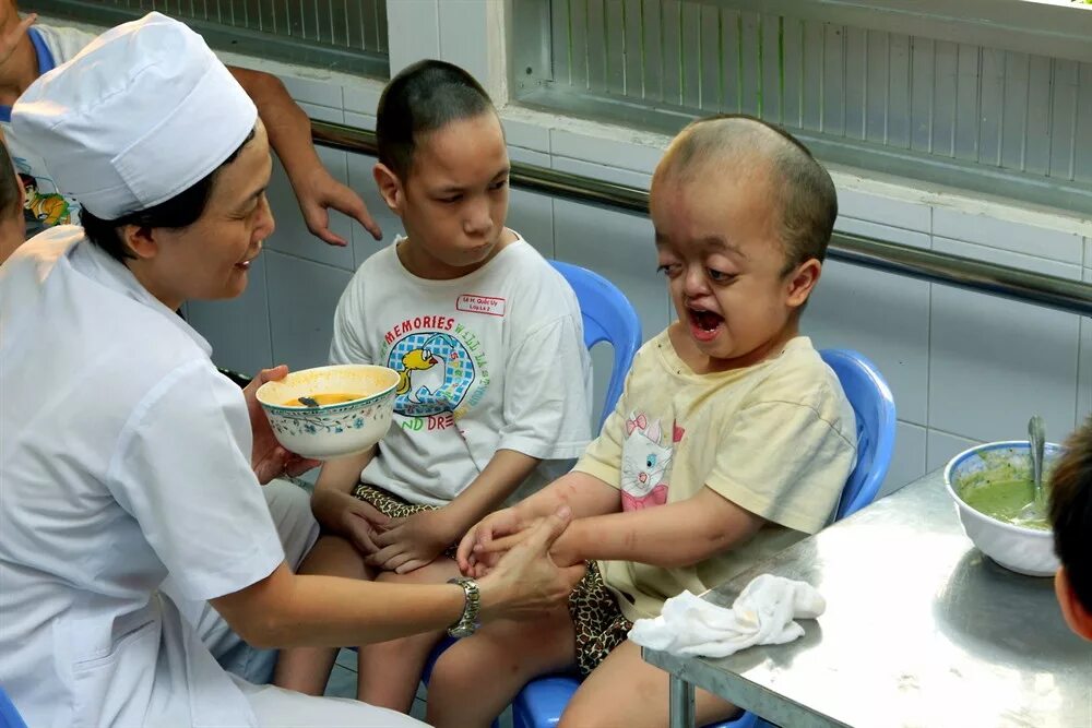 Инвалиды уроды. Вьетнам агент оранж дети. Агенторандж Вьетнам последствия.