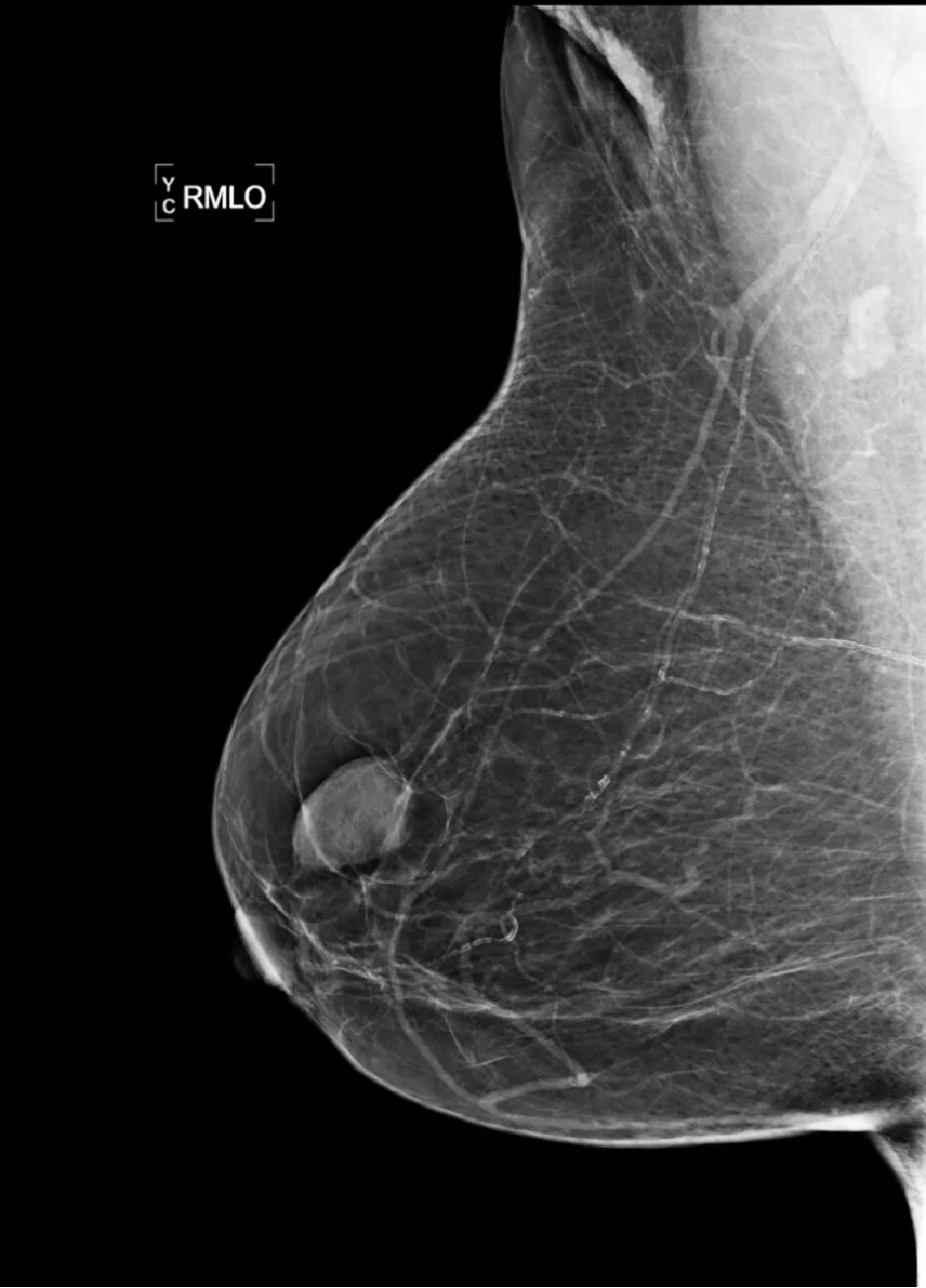 Маммография фкм. Узловая фиброзно-кистозная мастопатия. Маммограмма мастопатия. Фиброзная мастопатия маммограмма.