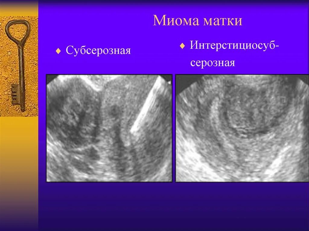 Субсерозная миоматозный узел. Миома матки стадии