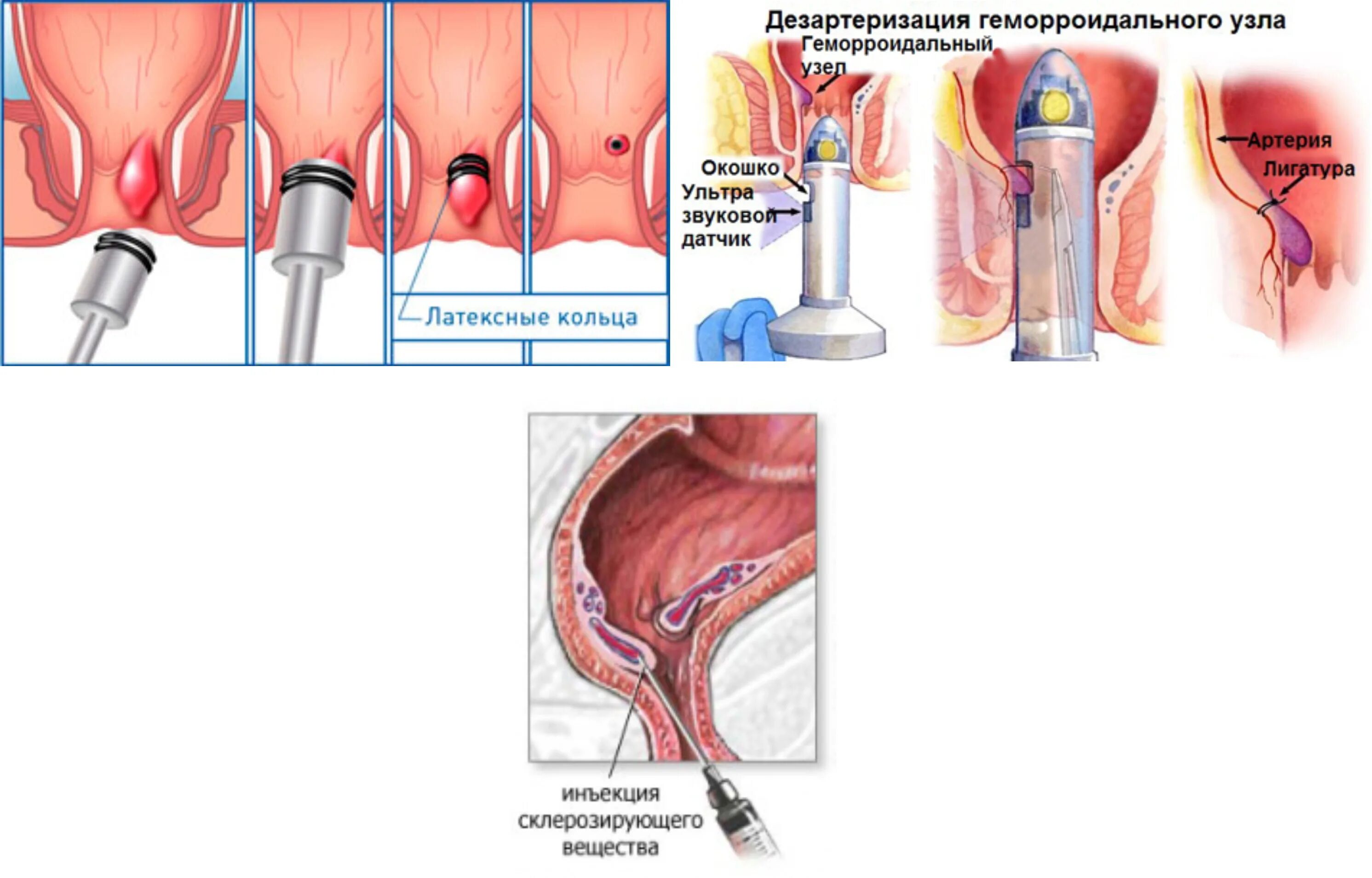 Дезартеризация геморроидальных узлов. Латексное лигирование геморроидальных узлов. Лигирование внутренних геморроидальных узлов. Наружный геморрой лигирование. Малоинвазивное лечение геморроя