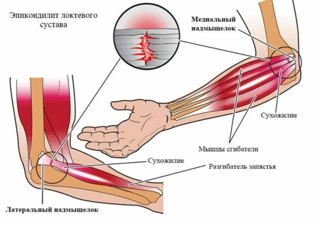 Растяжение предплечья симптомы