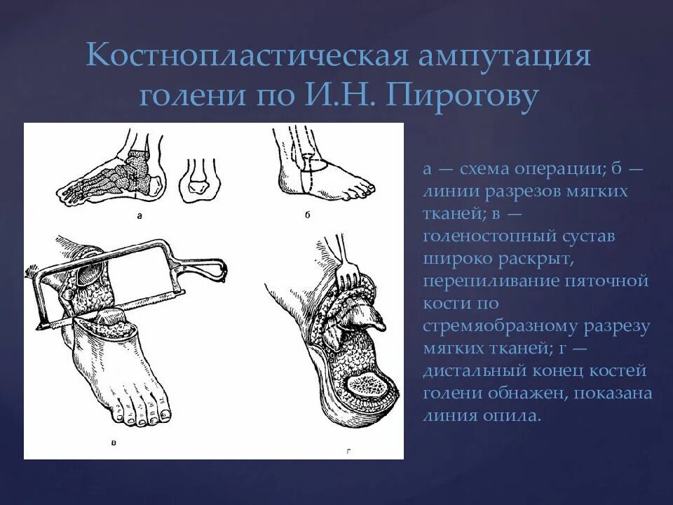 Костно пластическая ампутация Пирогова. Костнопластическая ампутация по н.и. Пирогову. Костно пластическая ампутация голени по Пирогову. Ампутация по Шопару схема.