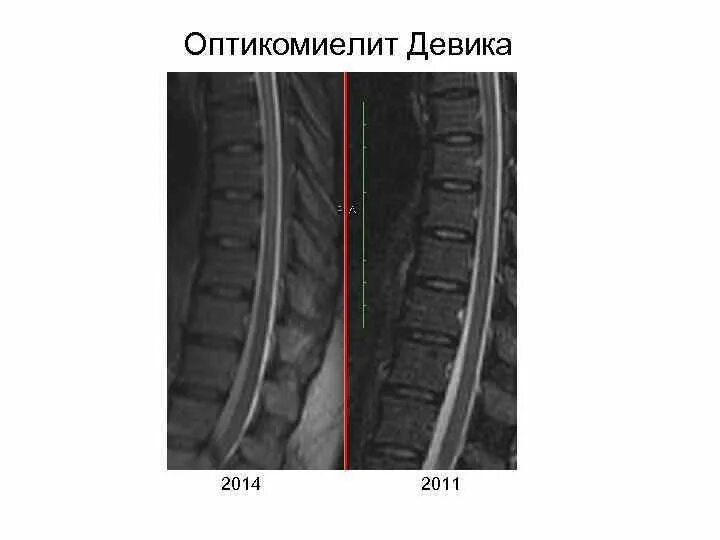 Оптикомиелит девика симптомы. Болезнь девика. Нейромиелит девика. Заболевание спектра оптиконевромиелита. Заболевание спектра оптиконевромиелита.