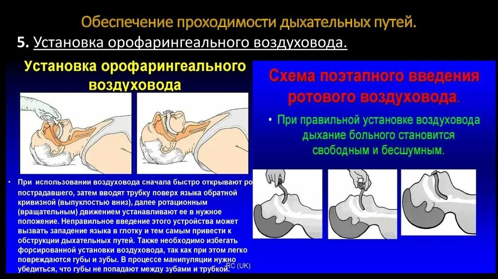 Какие мероприятия по поддержанию проходимости дыхательных. Обеспечение проходимости дыхательных путей. Методы проходимости дыхательных путей. Приемы восстановления проходимости дыхательных путей. Обеспечение проходимости дыхательных путей алгоритм.