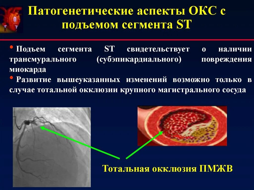 Острый коронарный синдром инфаркт. Остром коронарном синдроме с подъемом сегмента St. Острый коронарный синдром клиническая картина. Коронарный синдром без подъема сегмента St. Окс подъем сегмента St.