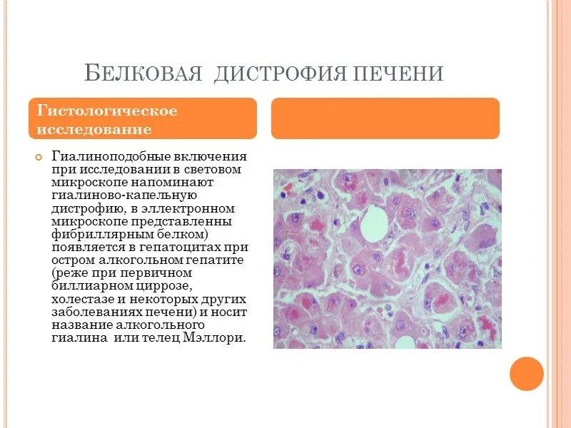 Признаки дистрофии печени. Жировая дистрофия почек патанатомия. Гидропическая дистрофия гепатоцитов. Зернистая дистрофия печени гистология. Патологическая гистология печени.