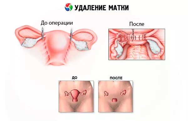 Удаление матки (гистерэктомия).