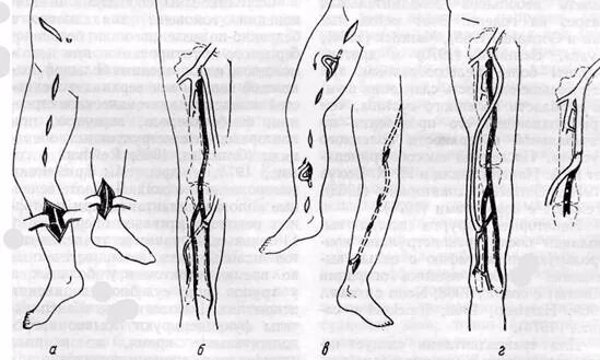 Шунтирование бедренно подколенной артерии. Шунтирование вены нижних конечностей. Шунт артерии нижних конечностей. Шунтирование вен нижних конечностей операция. Операция шунтирование ног