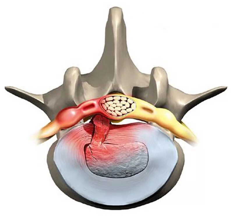Межпозвонковая грыжа поясничного отдела лечение. Грыжа диска позвоночника. Грыжа межпозвонкового диска. Грыжа междисковая позвоночная. Грыжа и протрузия поясничного отдела.