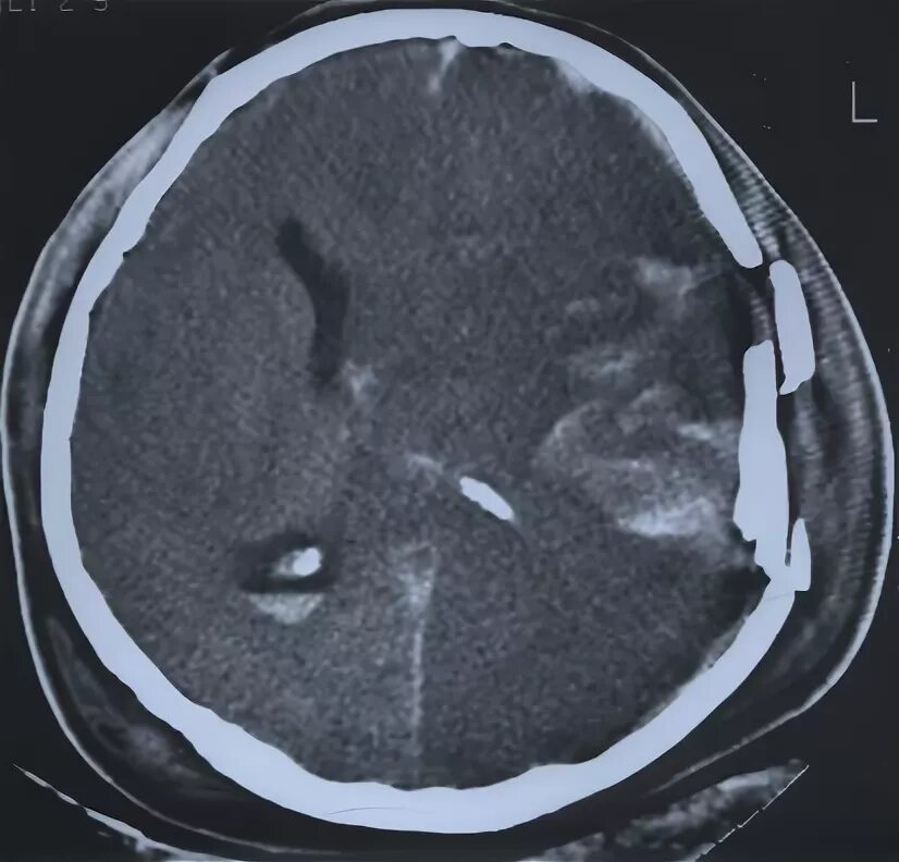 Насколько вредно кт. Оскольчатый перелом черепа кт. Кт головного мозга перелом лобной.