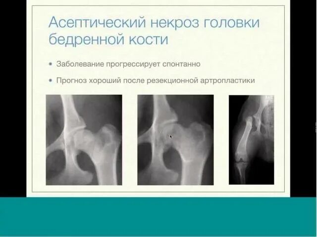 Асептический некроз коленного сустава рентген. Асептический некроз головки тазобедренного сустава рентген. Асептический некроз бедренной кости кт. Асептический некроз плечевого сустава кт.