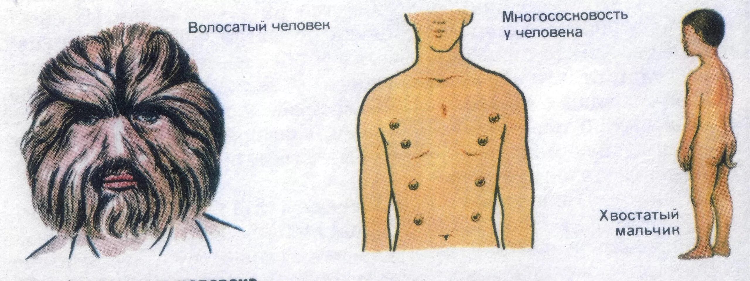 Люди с хвостами в реальной жизни. Волосяной Покров человека атавизм. Рудименты человека атавизмы человека. Атавизмы у человека многососковость.