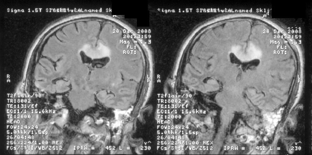 Гематома мозолистого тела кт. Кт мозга геперобластома. Глиобластома головного мозга на кт.
