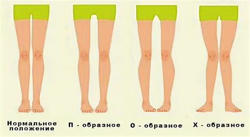 Какие должны быть ноги. П образная кривизна ног. П образные ноги у девушек. П образная форма ног.