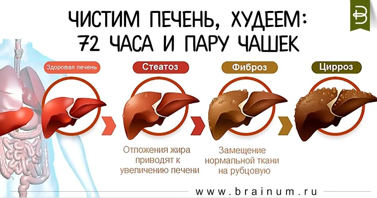 Как вылечить ожирение печени. Стадии поражения печени алкоголем. жировой гепатоз и цирроз печени. сдютадти жирового гепатоза печени. стадии разрушения печени.