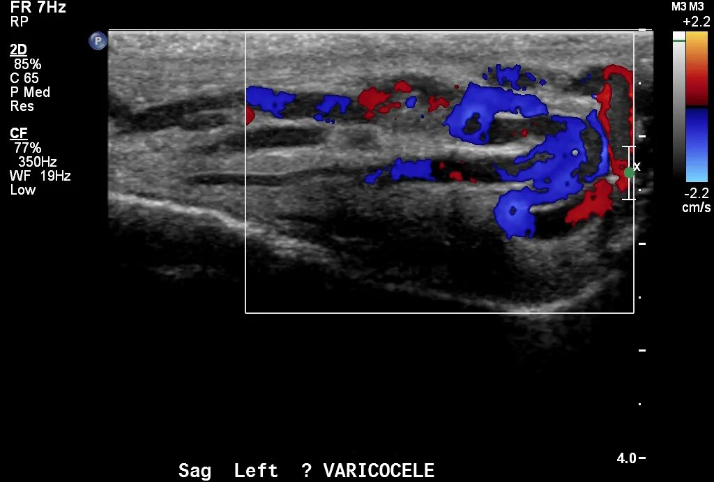 Расширение семенной вены. Доплер сосудов УЗИ мошонки. Вены семенного канатика на УЗИ. Вены семенного канатика норма УЗИ. Варикоцеле слева УЗИ.
