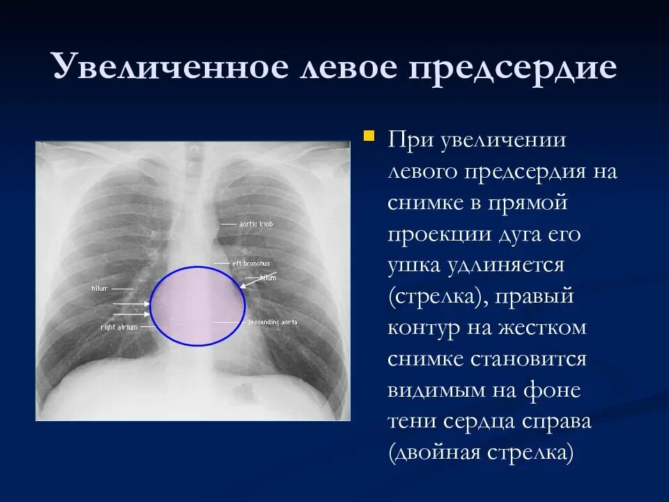 Что значит сердце увеличено влево. Увеличение левого предсердия рентген. увеличение левого предсердия на рентгенограмме. левое предсердие увеличено рентген.