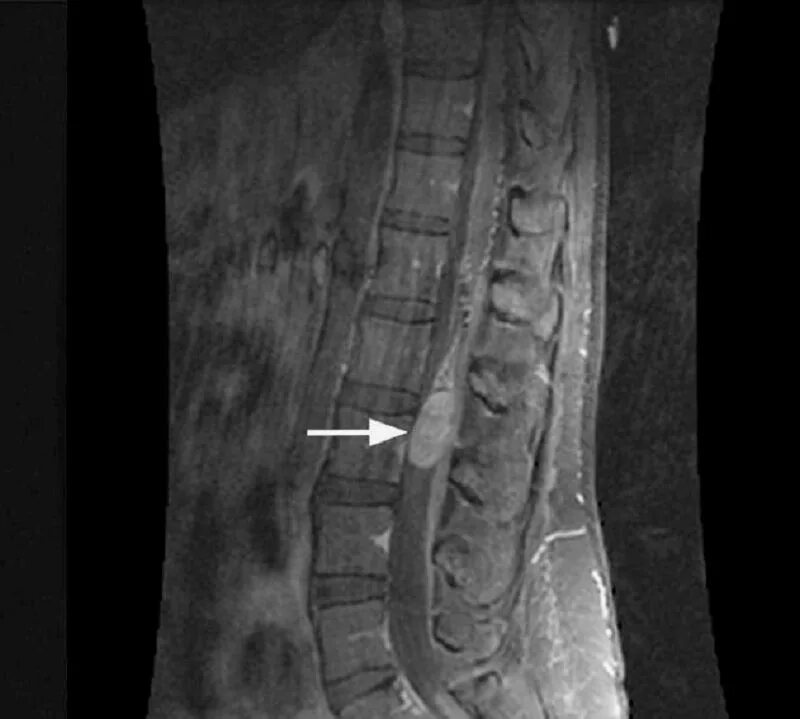 Эпендимома поясничного отдела позвоночника мрт. Эпендимома конского хвоста спинного мозга. Эпендимома спинного мозга мрт. Опухоль позвоночника поясничного отдела на мрт. Опухоль в поясничном отделе