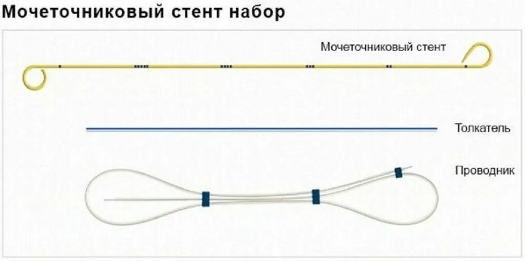 Стент мочеточника отзывы