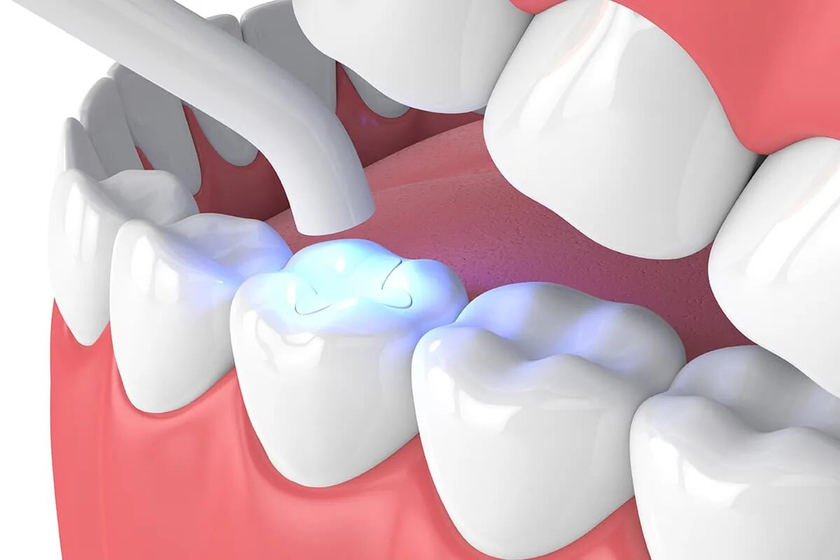Пломба композита светоотверждаемого. Световая фотополимерная пломба. Зубная пломба фотополимерная. Реставрация фотополимером