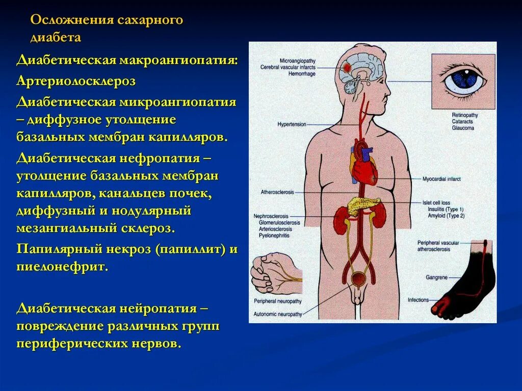 Диабет с множественными осложнениями. Диабетические осложнения. Сахарный диабет последствия и осложнения.