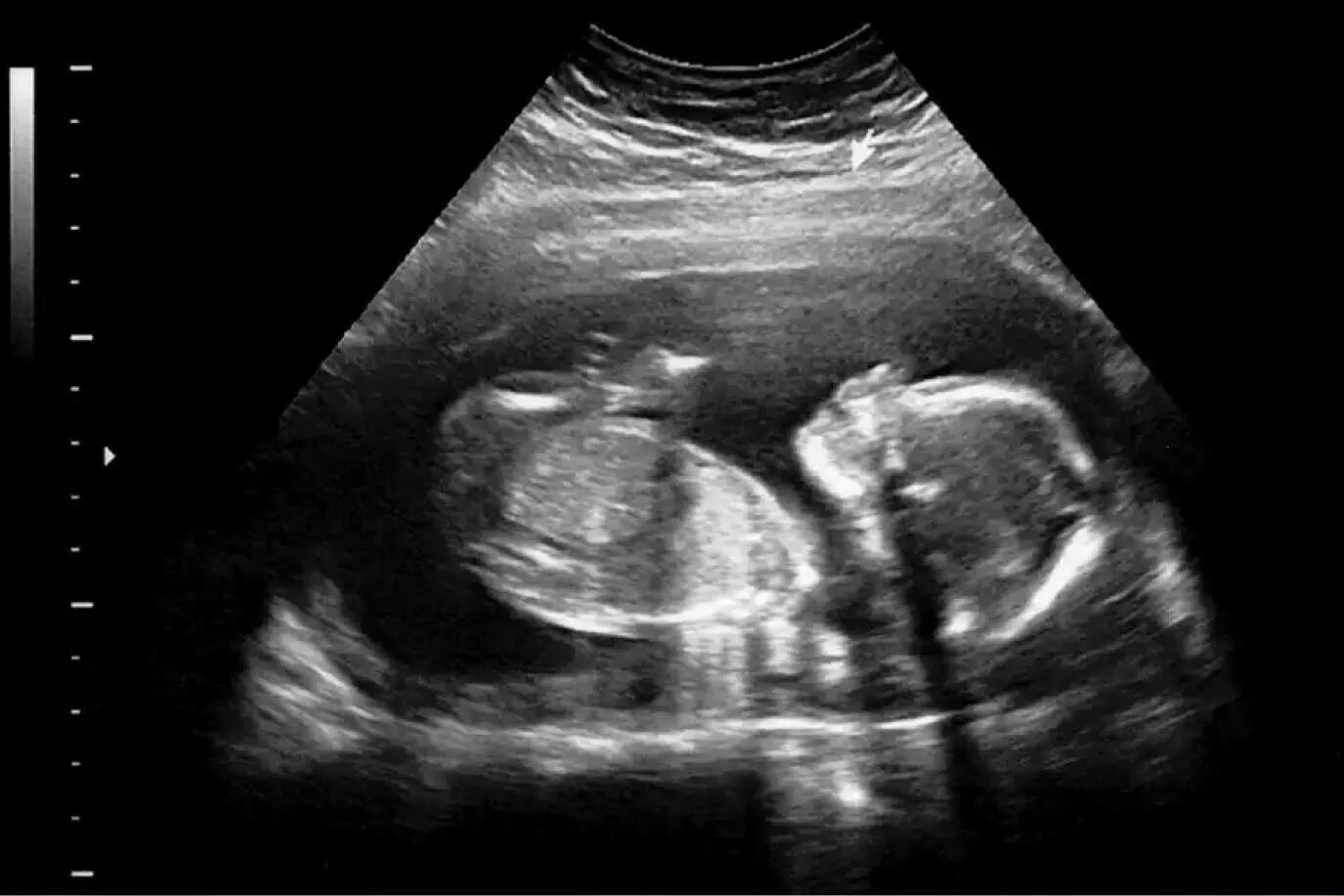 УЗИ девочки на 20 неделе беременности. УЗИ 20 недель беременности фото. УЗИ мальчика снимки 22 недели беременности. Фото плода на 20 неделе беременности УЗИ девочка. Узи на 39 неделе