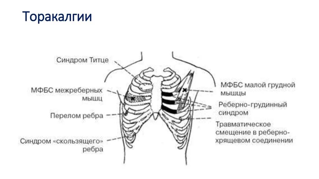 Между ребрами посередине спереди. Синдром Титце грудная клетка. Болит посередине грудины. При вдохе болят ребра спереди