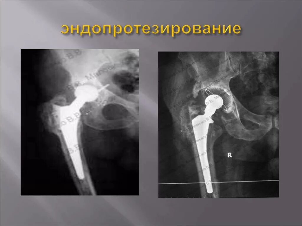 Чебоксары суставы операция. Эндопротезирование молоточка кт. Эндопротезирование в 16 лет. Эндопротезирование в СССР. Эндопротезирование шейки бедра в возрасте 85 лет..