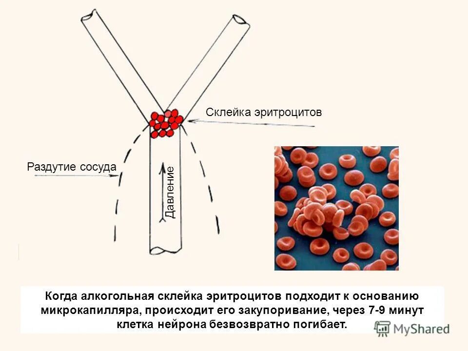 Склеивание эритроцитов. Закупорка сосуда склейкой эритроцитов. алкогольная склейка эритроцитов.