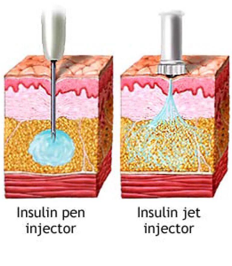 Техника набора инсулина. Инъекция инсулина алгоритм. Подкожная инъекция инсулина алгоритм. Способы введения инсулина. Методы парентерального введения инсулина.