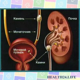 Моча из пузыря в почки