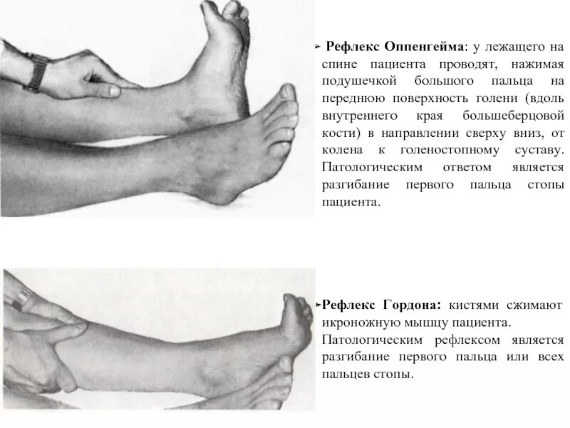 Рефлексы Бабинского, Оппенгейма, Россолимо. Рефлекс Бабинского Оппенгейма Гордона. Симптом Оппенгейма неврология. Рефлексы (Оппенгейма, Шеффера, Бабинского, Россолимо, Гордона.