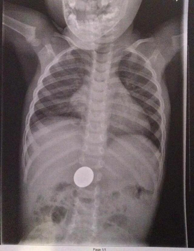 Проглотил через сколько выйдет. Инородный предмет в желудке. Монета в желудке у ребенка на рентгене.