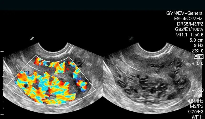 варикозное расширение вен малого таза у женщин узи. варикозное расширение вен матки на узи. варикозное расширение вен малого таза узи. варикозное расширение матки. расширение сосудов матки.