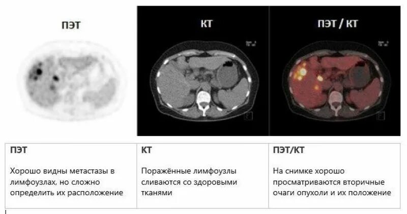 ПЭТ/кт с туморотропными РФП (18f-фтордезоксиглюкоза). ПЭТ кт исследование онкология. Пэт кт или кт что лучше