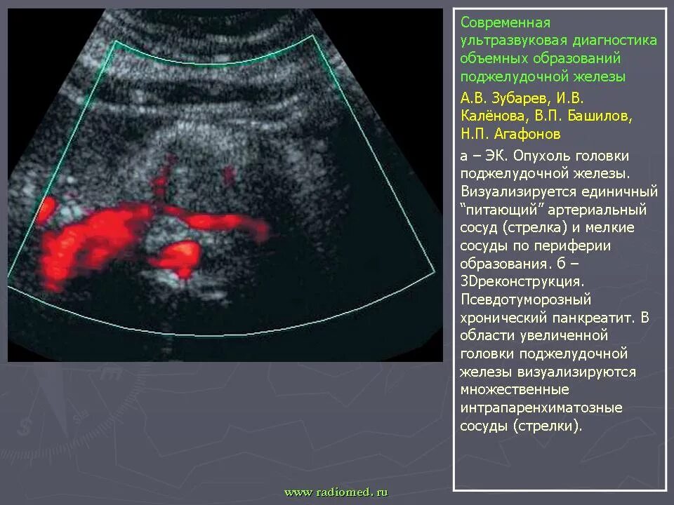 Ультразвуковое исследование поджелудочной железы позволяет выявить:. УЗИ диагностика поджелудочной железы болезни. УЗИ брюшной полости поджелудочная железа. Исследование поджелудочной железы на УЗИ. На узи виден желудок