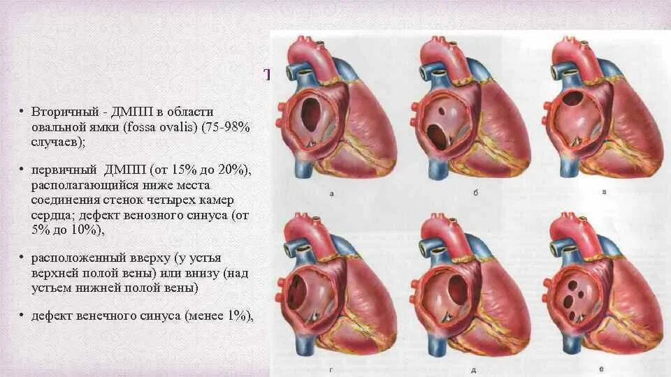Врожденный порок сердца ДМПП. При врожденных пороках сердца..
