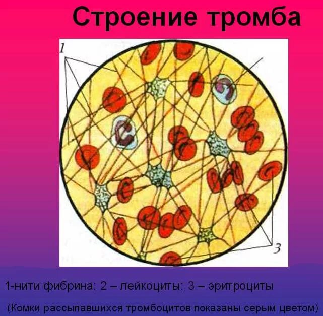 Строение тромба. Структура тромба.