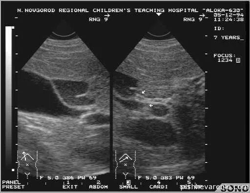 Перегиб желчного пузыря что делать. Загиб желчного пузыря на УЗИ. Перегиб желчного пузыря на УЗИ. Перегнутый желчный пузырь. УЗИ признаки перегиба желчного пузыря.