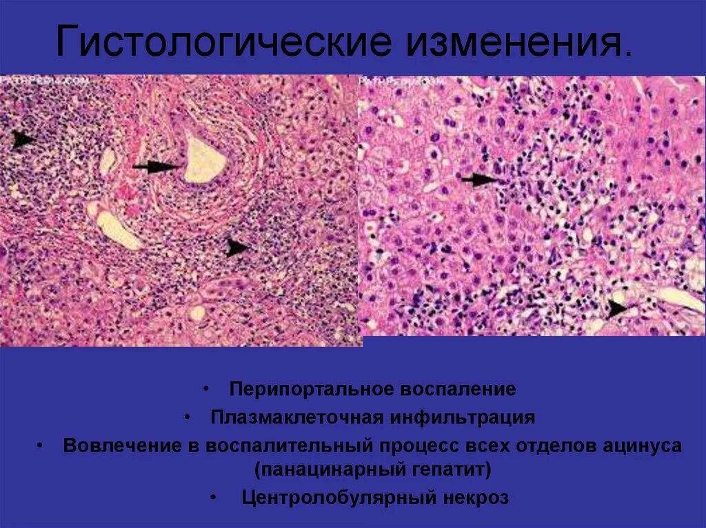 Аутоиммунная печени. Цирроз печени гистология. Аутоиммунный гепатит гистологическая картина. Аутоиммунный гепатит биопсия печени. Аутоиммунный гепатит патанатомия.