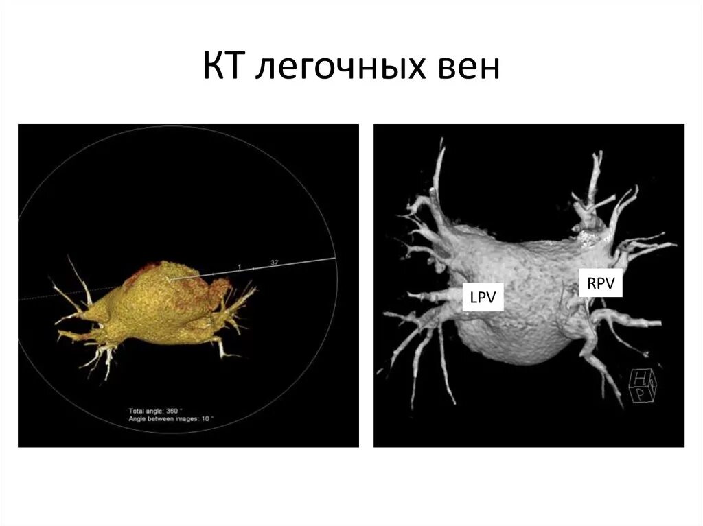 Кт устьев легочных вен. Что такое компьютерная томография легочных вен. Изоляция легочной вены