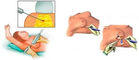 Пункция молочных желез