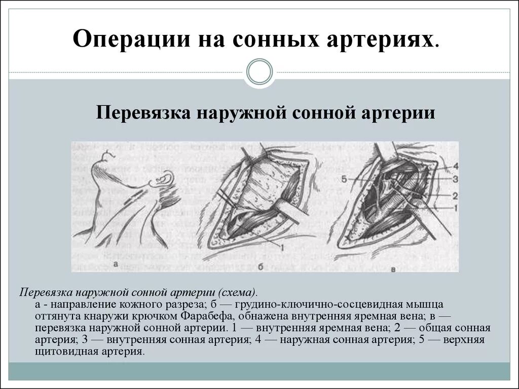 Перевязка наружной сонной артерии операция. Перевязка общей сонной артерии топографическая анатомия. Операции на сонных артериях топографическая анатомия. Обнажение и перевязка наружной сонной артерии.