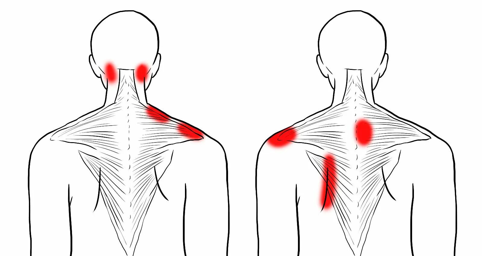 Сводить левую сторону. Трапециевидная мышца спины триггерные точки. Триггерные точки шейного отдела позвоночника. Триггерные точки шейно-воротниковой зоны. Триггерные точки плеча и шеи.